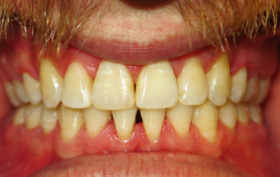 before and after