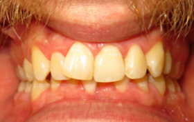 before and after