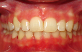 before and after