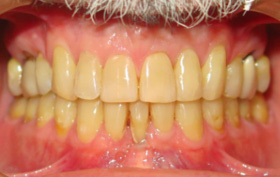 before and after