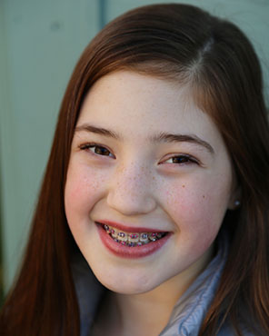 types of braces